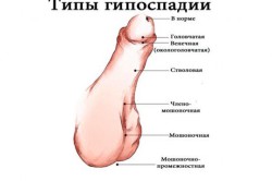 Типы гипоспадии Типы гипоспадии