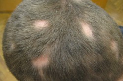 Гнездовая алопеция Гнездовая алопеция