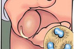 Схема проявления острой гонореи