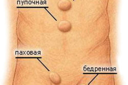 Виды грыжи Виды грыжи