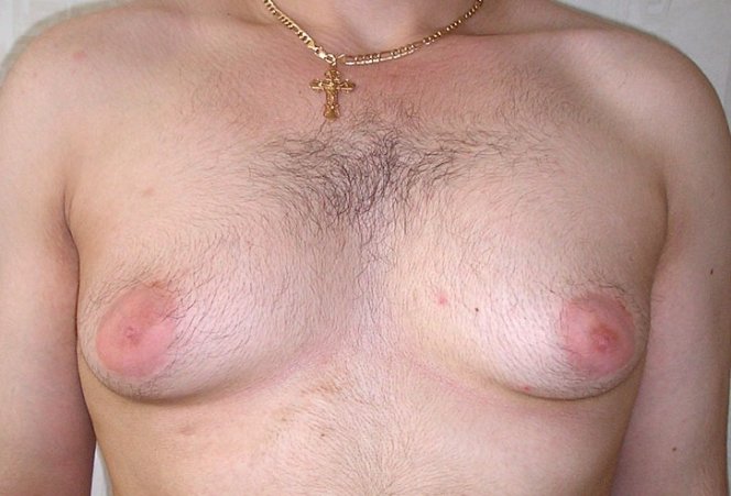 Грудь у мужчины Грудь у мужчины