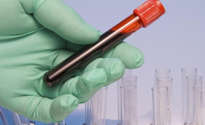 Кровь, взята на анализ Кровь, взята на анализ