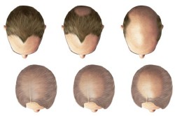 Диффузная алопеция