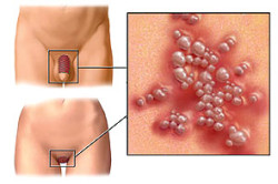 Герпес Герпес