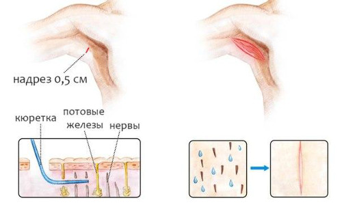Хирургическое лечение гипергидроза Хирургическое лечение гипергидроза