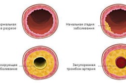 Влияние холестерина на сосуды Влияние холестерина на сосуды