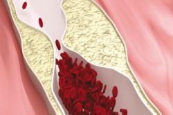 Нарушение притока крови Нарушение притока крови