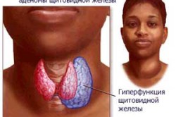 Аденома щитовидной железы Аденома щитовидной железы