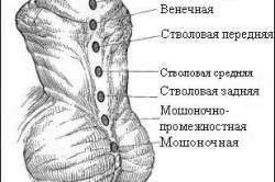 Гипоспадия - смещение мочеиспускательного канала Гипоспадия - смещение мочеиспускательного канала