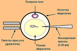 Схема интрацитоплазматической инъекции сперматозоида Схема интрацитоплазматической инъекции сперматозоида