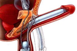 Фаллопротез Фаллопротез