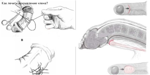 Лечение искривления члена Лечение искривления члена