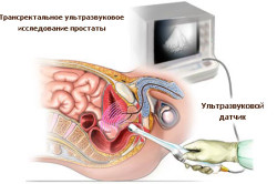 УЗИ предстательной железы УЗИ предстательной железы