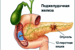 Истинная киста Истинная киста