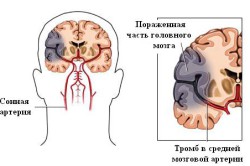 Распознавание микроинсульта Распознавание микроинсульта