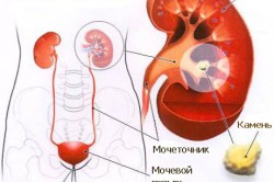 Камни в почках Камни в почках