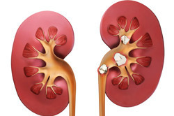 Камни в почках Камни в почках