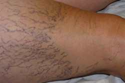 Стадии варикоза у мужчин Стадии варикоза у мужчин