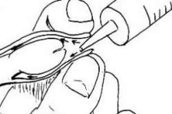 Закапывание каплей Закапывание каплей