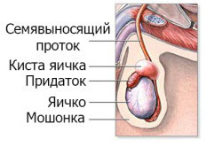Киста яичка Киста яичка