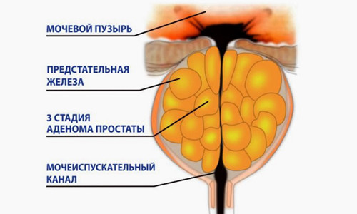 Киста Киста