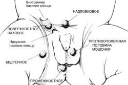 Крипторхизм - одно из заболеваний, свойственных мужчинам Крипторхизм - одно из заболеваний, свойственных мужчинам