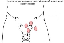 Варианты расположения яичек при крипторхизме Варианты расположения яичек при крипторхизме