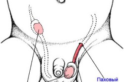 Крипторхизм - основная причина опухолей Крипторхизм - основная причина опухолей