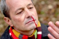 Частые кровотечения из носа признак низкого уровня тромбоцитов в крови