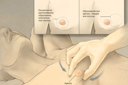 Определение гинекомастии Определение гинекомастии