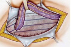 Лечение паховой грыжи Лечение паховой грыжи