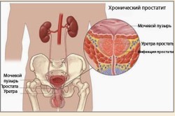 Лечение хронического простатита Лечение хронического простатита