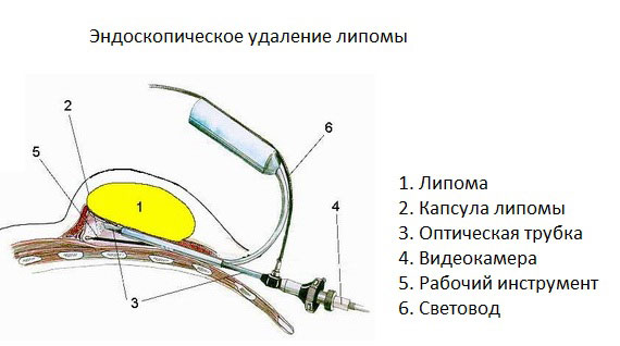 Удаление липомы Удаление липомы