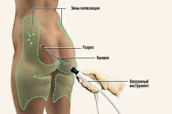 Липосакция Липосакция