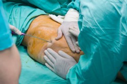 Липосакция спины и боков у мужчин Липосакция спины и боков у мужчин