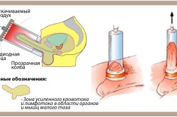 ЛОД-терапия ЛОД-терапия