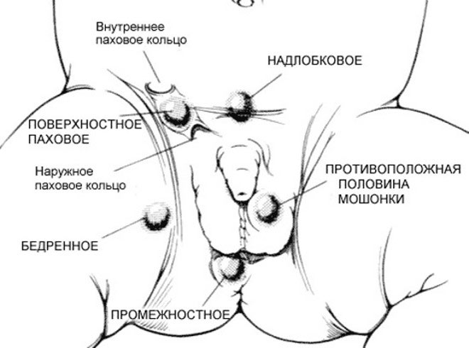 Возможная локализация эктопических (не опустившихся) яичек Возможная локализация эктопических (не опустившихся) яичек