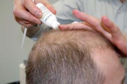 Нанесение лосьена от выпадения волос Нанесение лосьена от выпадения волос