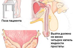 Массаж простаты Массаж простаты