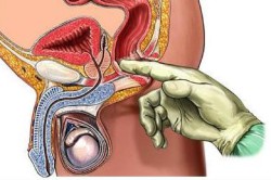 Массаж и исследование простаты Массаж и исследование простаты