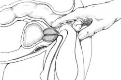 Массаж простаты Массаж простаты