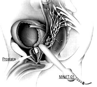 Лечение простатита физиопроцедурами Лечение простатита физиопроцедурами