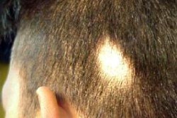 Алопеция очаговая Алопеция очаговая