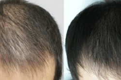 Результаты мезотерапии корней волос Результаты мезотерапии корней волос