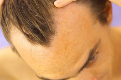 Мезотерапия