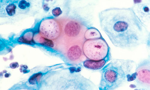 Мазок с микроорганизмами Chlamydia trachomatis под микроскопом Мазок с микроорганизмами Chlamydia trachomatis под микроскопом