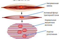 Триггерная точка Триггерная точка