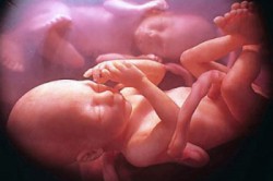 Многоплодная беременность