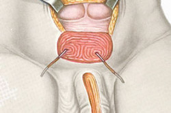 Экстрофия мочевого пузыря Экстрофия мочевого пузыря