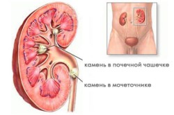 Мочекаменная болезнь - одна из возможных причин кровотечения